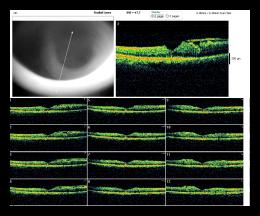 RADIAL LINE OD